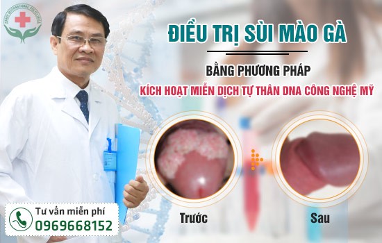 điều trị bệnh sùi mào gà